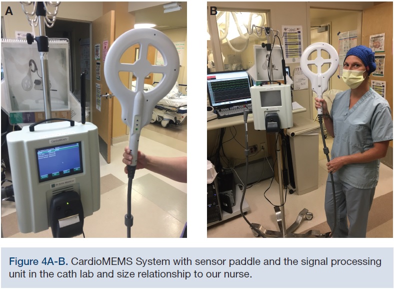An Implantable Pulmonary Artery Pressure Monitoring Sensor to Improve